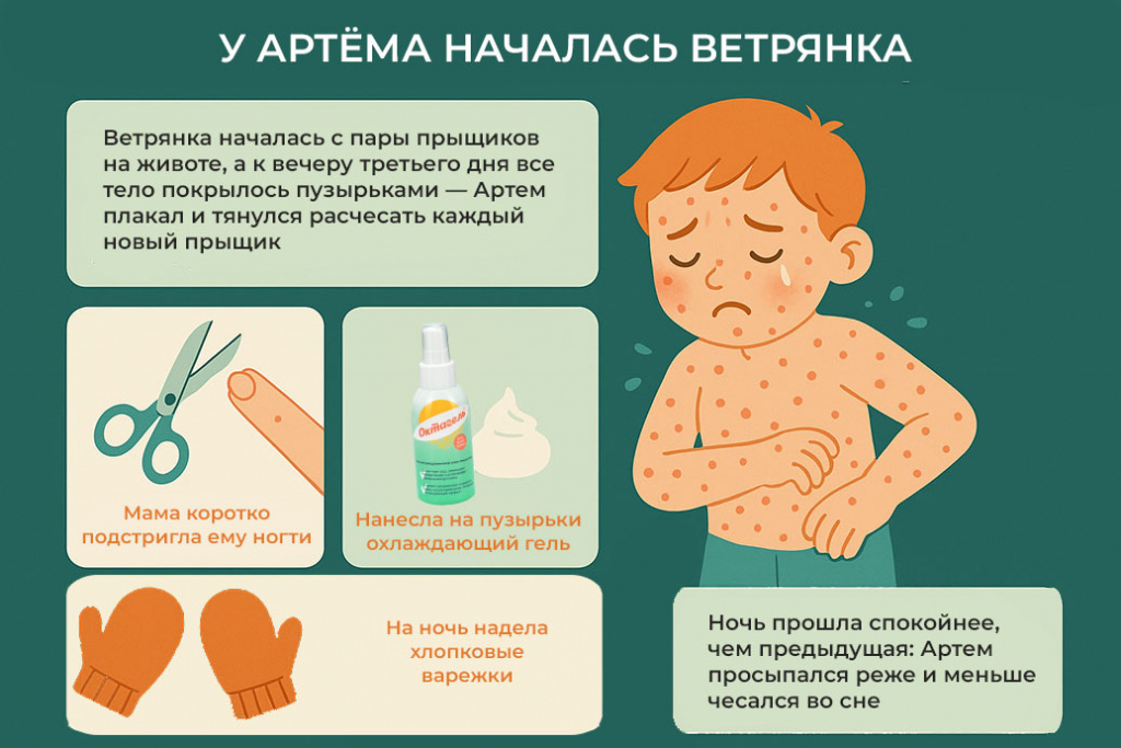 как-уменьшить-зуд-при-ветрянке